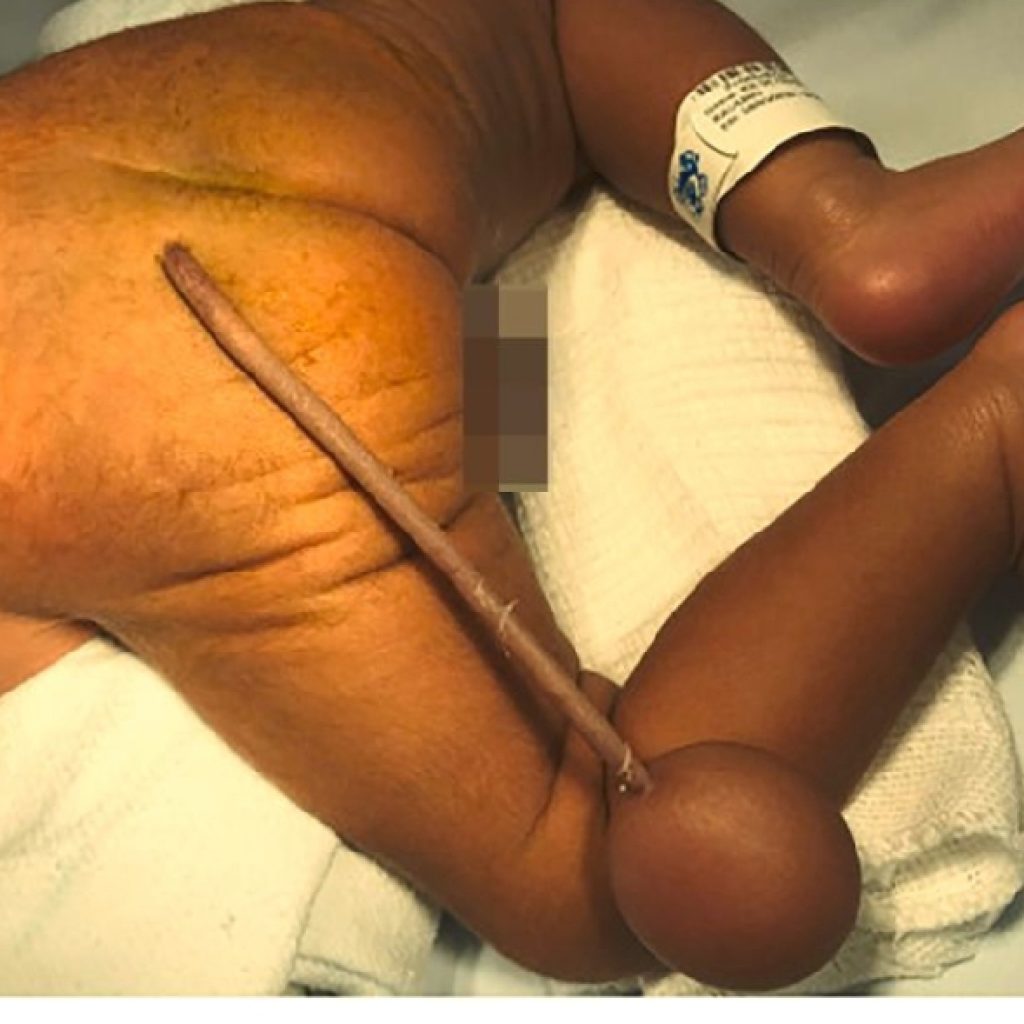 Brésil : un bébé naît avec une queue de 12 cm (photos)